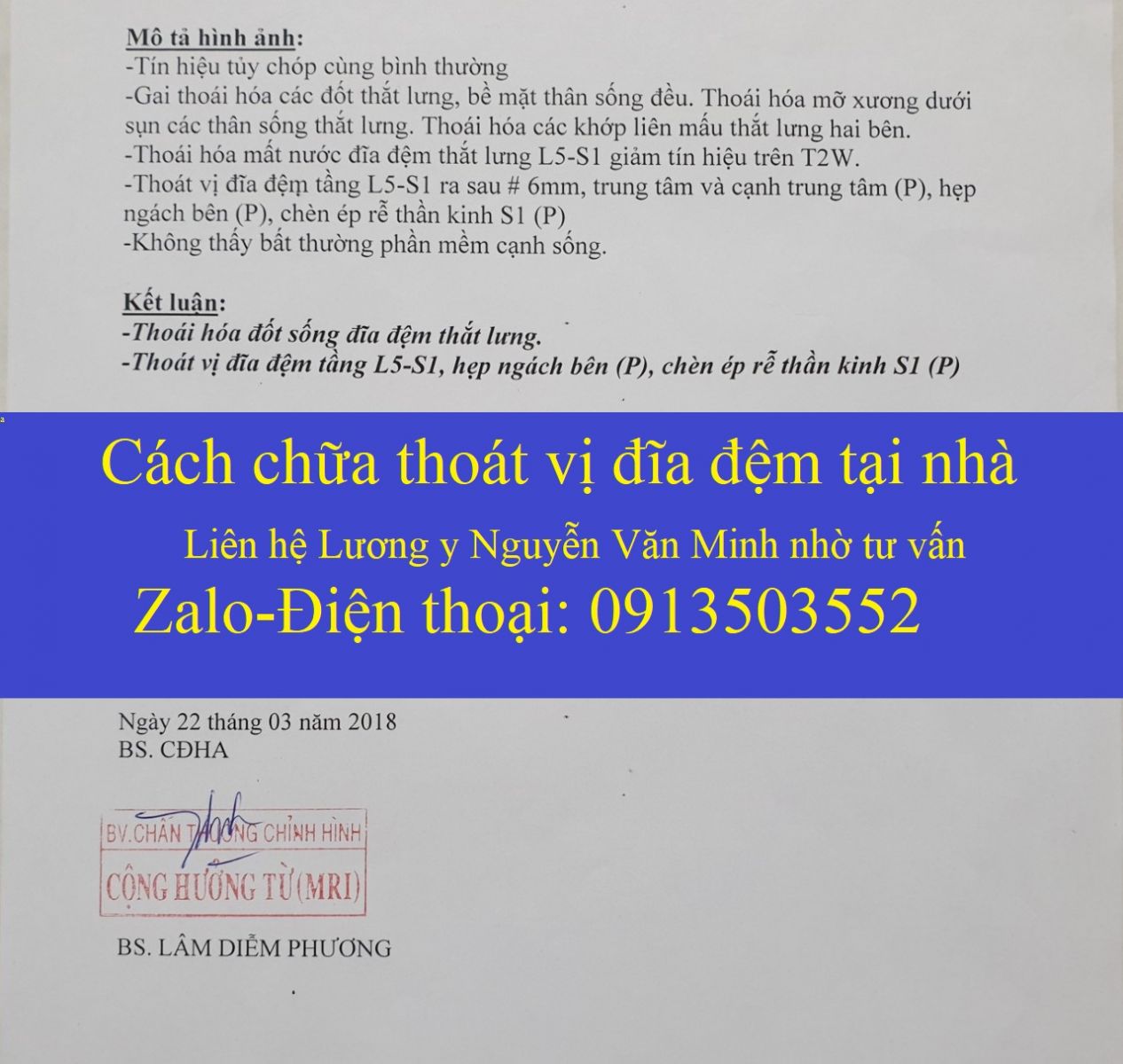 Cách chữa thoát vị đĩa đệm tại nhà